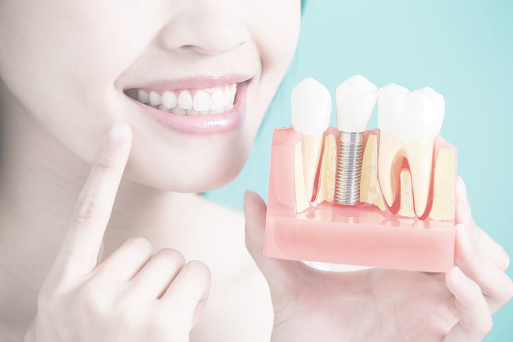 Quelle est la différence entre un implant dentaire et un pivot